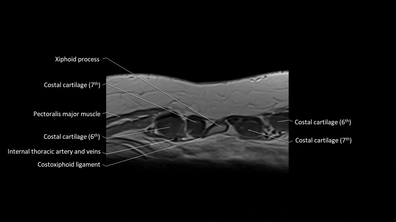MRI sternum and sternoclavicular joint labeled axial anatomy image 36.webp
